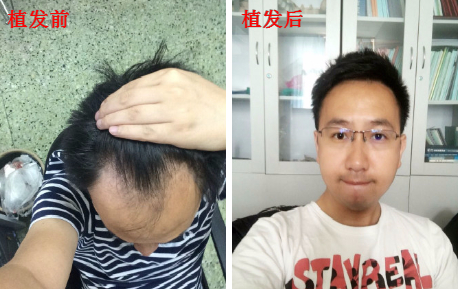 新疆烏魯木齊領(lǐng)美植發(fā)3200單位，看看植完發(fā)后效果怎么樣