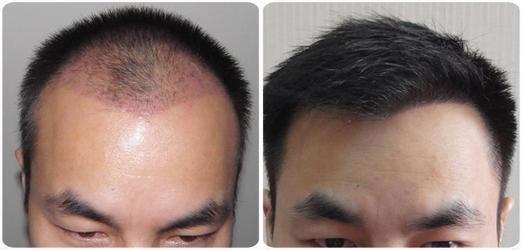 長沙植發(fā)多少錢一個毛囊單位，附長沙植發(fā)案例分享