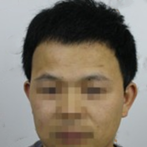 南昌植發(fā)手術(shù)需要多少費用，我在南昌植發(fā)2000個毛囊效果分享