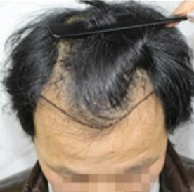 南昌植發(fā)手術(shù)需要多少費用，我在南昌植發(fā)2000個毛囊效果分享