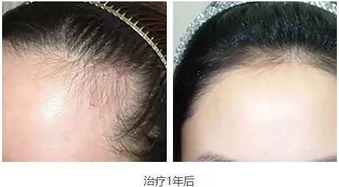 東莞植發(fā)好不好？在東莞正規(guī)植發(fā)醫(yī)院進(jìn)行手術(shù)后的真實(shí)分享