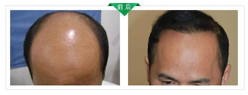 寧波的頭發(fā)種植一般需要多少錢？