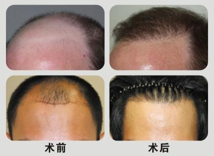 合肥植發(fā)什么價(jià)位？合肥植發(fā)哪家好？