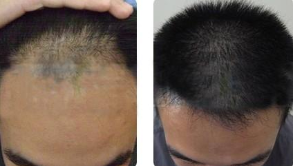 合肥植發(fā)什么價(jià)位？合肥植發(fā)哪家好？