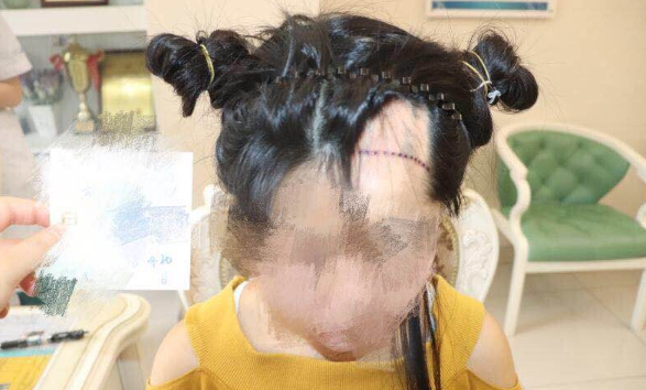 成都大麥微針植發(fā)1400單位，疤痕種植術(shù)后體驗(yàn)