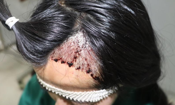 成都大麥微針植發(fā)1400單位，疤痕種植術(shù)后體驗(yàn)