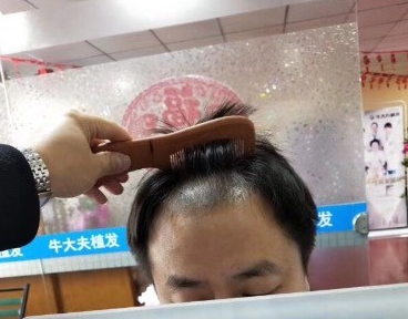 沈陽牛大夫植發(fā)3500單位，一起看下我的術(shù)后真實(shí)效果