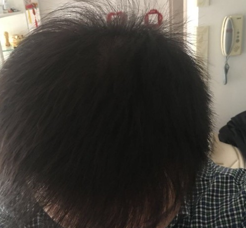 沈陽牛大夫植發(fā)3500單位，一起看下我的術(shù)后真實(shí)效果