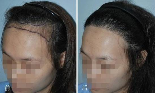 大麥微針調(diào)整發(fā)際線1500個單位，看看下調(diào)后的術(shù)后效果