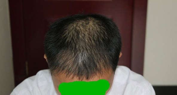2級(jí)脫發(fā)植發(fā)經(jīng)歷，我植發(fā)2200單位來看看我的術(shù)后效果
