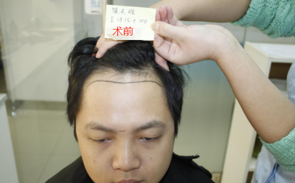 深圳雍禾發(fā)際線調(diào)整1900單位，看六個月后的手術(shù)效果