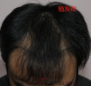 在上海雍禾植發(fā)3200單位，看看術后六個月是什么樣子的