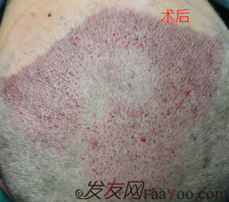 西安大麥微針植發(fā)3100單位，分享我的術(shù)后經(jīng)歷