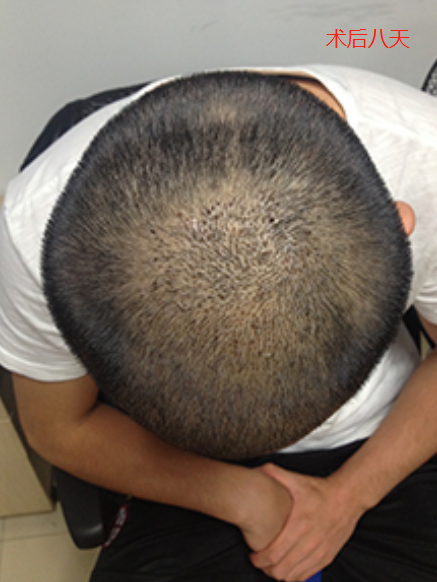 上海大麥微針植發(fā)3900個(gè)毛囊單位，大家來看看我的術(shù)后效果