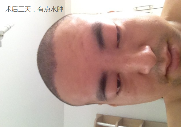 中美植發(fā)3100單位無痕植發(fā)，分享我的植發(fā)經(jīng)歷