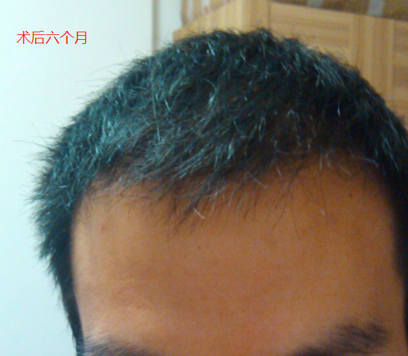 南京大麥微針植發(fā)2100單位，希望手術后效果可以讓我很滿意