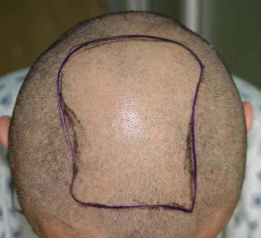 北京雍禾無痕加密植發(fā)3000單位，我的術(shù)后效果很讓人滿意