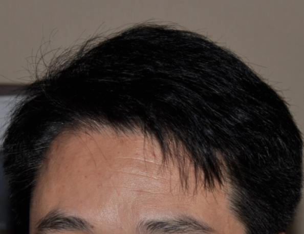 北京雍禾無痕加密植發(fā)3000單位，我的術(shù)后效果很讓人滿意