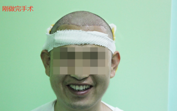 河北人在北京植發(fā)2500毛囊單位，看看術(shù)后效果怎么樣