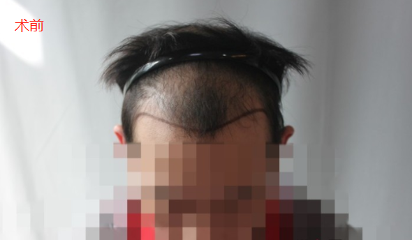 廣州新發(fā)現(xiàn)植發(fā)3000單位，和發(fā)友一起分享術(shù)后心得