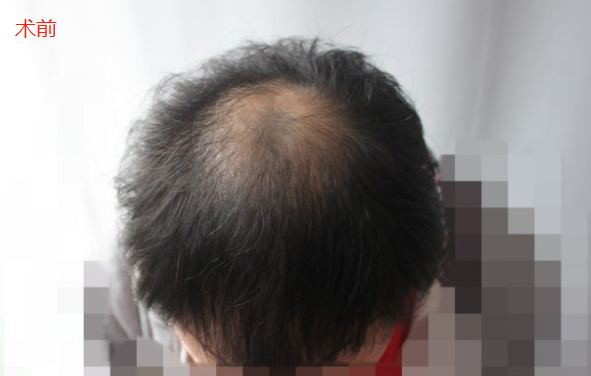 廣州新發(fā)現(xiàn)植發(fā)3000單位，和發(fā)友一起分享術(shù)后心得