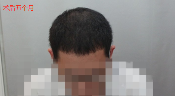 廣州新發(fā)現(xiàn)植發(fā)3000單位，和發(fā)友一起分享術(shù)后心得