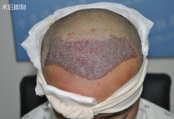 北京植發(fā)3000毛囊單位，和大家分享一下術(shù)后情況