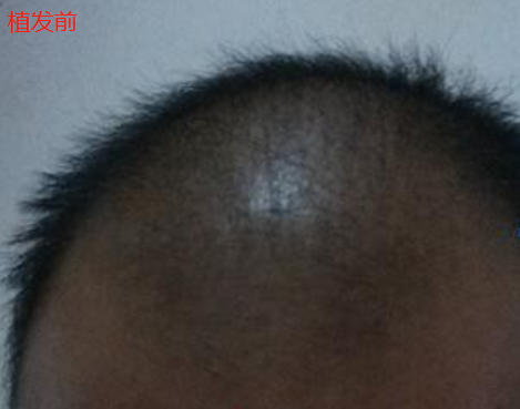 杭州大麥微針植發(fā)2300單位，我分享一下我的手術(shù)經(jīng)歷