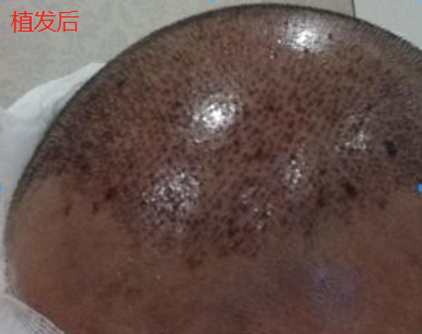 杭州大麥微針植發(fā)2300單位，我分享一下我的手術(shù)經(jīng)歷