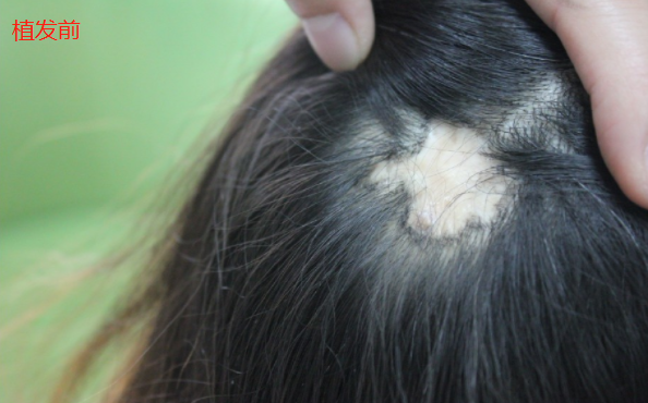 南京新生植發(fā)一年后，分享自己親身植發(fā)經(jīng)歷