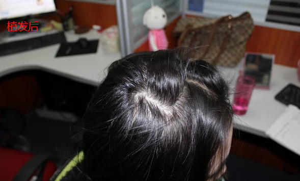 南京新生植發(fā)一年后，分享自己親身植發(fā)經(jīng)歷