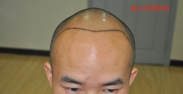 分享本人南寧植發(fā)經(jīng)歷，南寧大麥微針植發(fā)2600單位