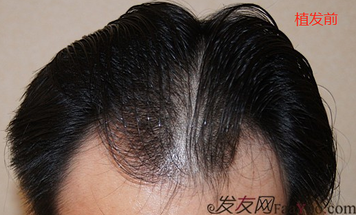 北京盛發(fā)園三級(jí)植發(fā)案例，植發(fā)8個(gè)小時(shí)術(shù)后效果