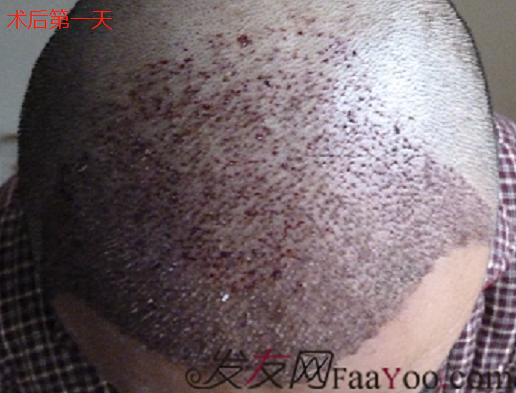 成都雍禾加密植發(fā)3000單位，看我詳細術(shù)后分享