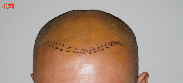 趕上植發(fā)優(yōu)惠大麥微針植發(fā)3000單位，看看術(shù)后效果