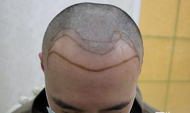 鄭州大麥微針植發(fā)醫(yī)院案例