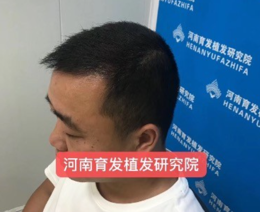 育發(fā)植發(fā)研究院案例