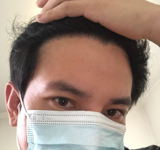 鄭州新生植發(fā)醫(yī)院案例