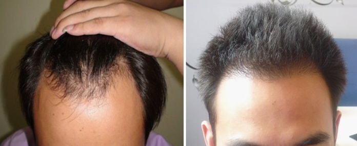 石家莊植發(fā)多少錢，在石家莊正規(guī)植發(fā)醫(yī)院真實經(jīng)歷