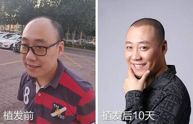 天津新發(fā)現(xiàn)植發(fā)3000單位，植發(fā)后分享經(jīng)驗