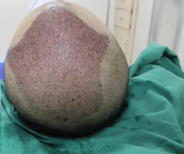 植發(fā)案例分享