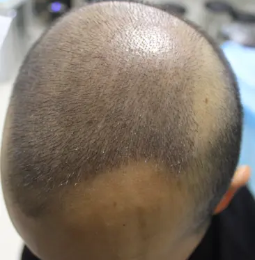 深圳大麥植發(fā)案例