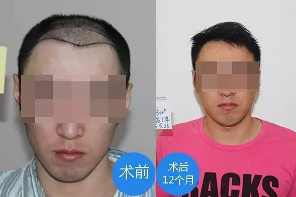 去廣州新發(fā)現(xiàn)植發(fā)案例，術(shù)后一年大家看我恢復的效果怎么樣
