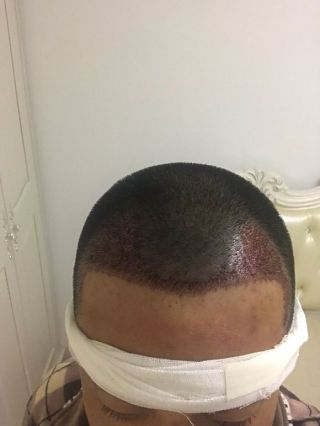 洛陽植發(fā)經(jīng)歷