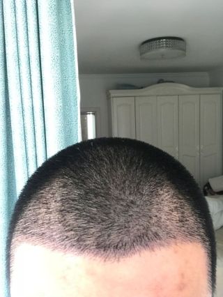 洛陽植發(fā)經(jīng)歷