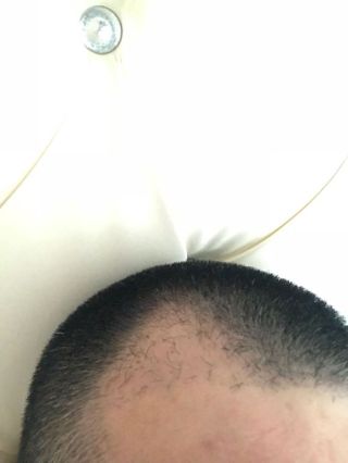 洛陽植發(fā)經(jīng)歷