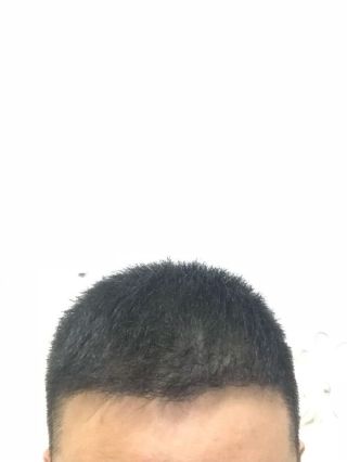 洛陽植發(fā)經(jīng)歷