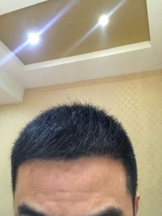 洛陽植發(fā)經(jīng)歷