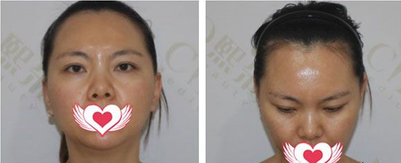 6000元植發(fā)效果圖