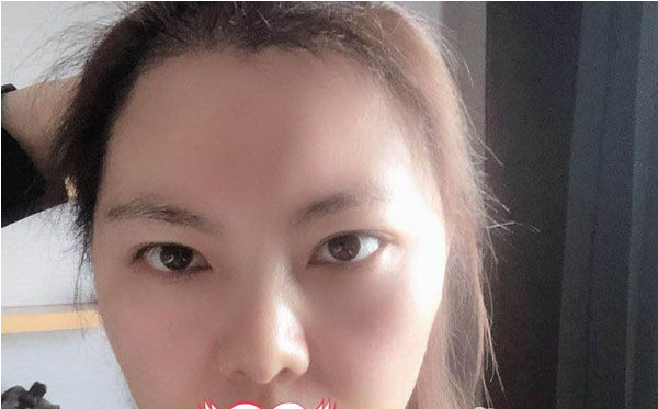 6000元植發(fā)效果圖